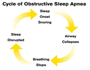 Sleep Apnea