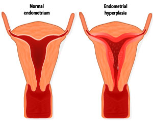 Endometrial Hyperplasia Symptoms