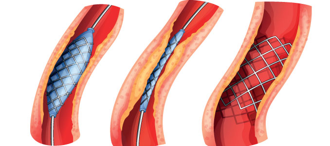 Atherosclerosis and HGH