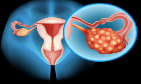 Ovarian Cancer