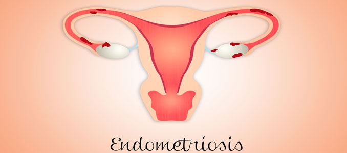 Endometriosis