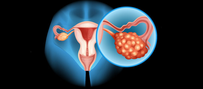 HRT For Ovarian Cancer