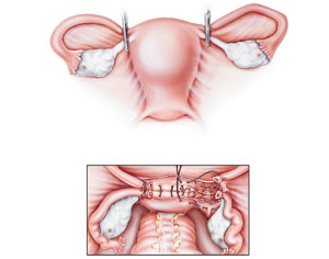 Hormone Therapy after Hysterectomy