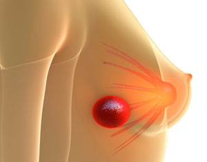 Breast Cancer and Progesterone Treatment