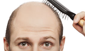 Baldness and Testosterone