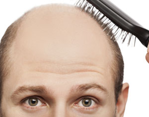 Hair Loss and Testosterone