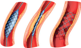 Growth Hormone and Atherosclerosis