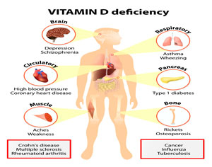 Deficiency of Vitamin D